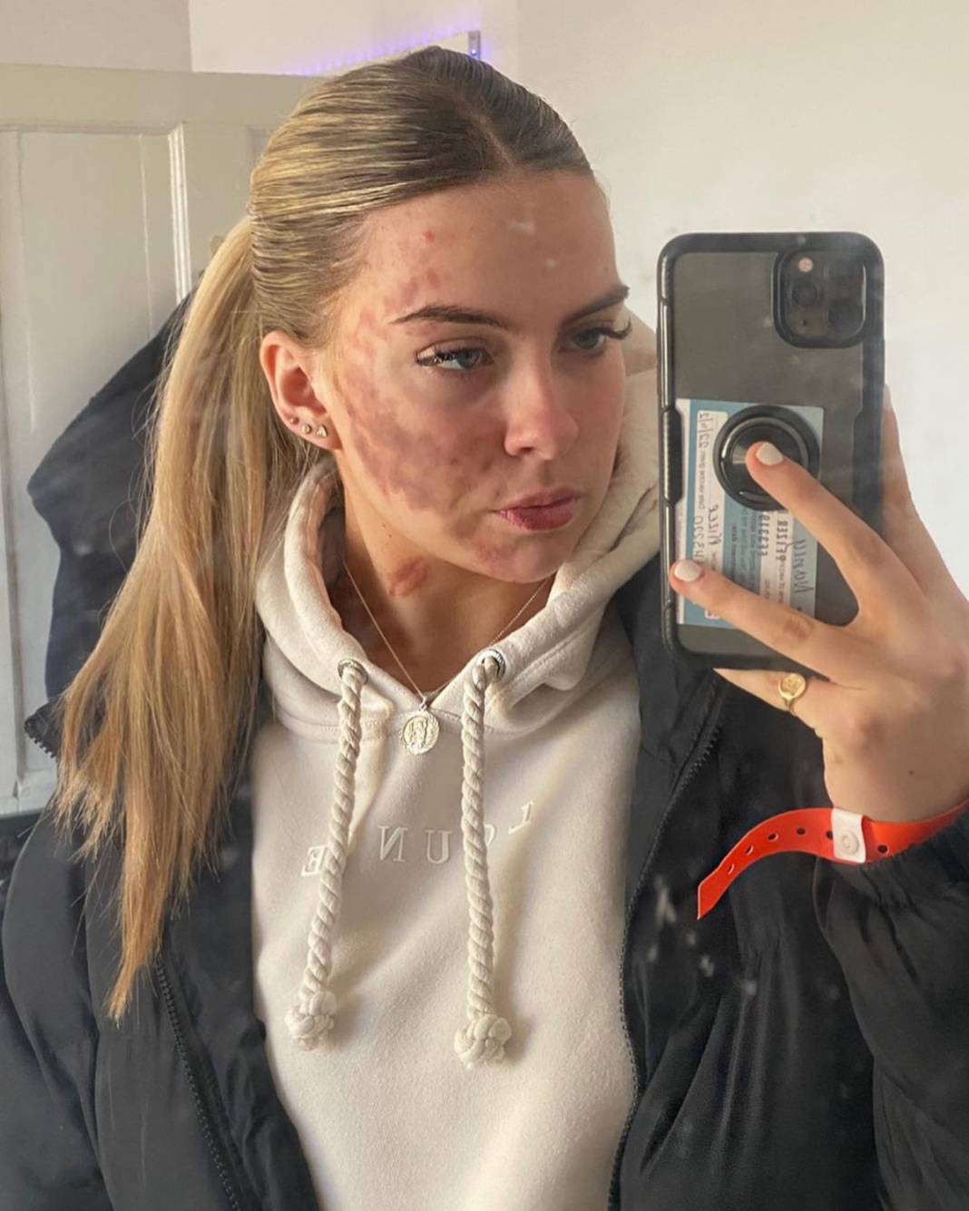 Basit bir uçuk zannetti, korkunç hastalığa yakalandı! Doktorlar bile teşhis koyamadı 9